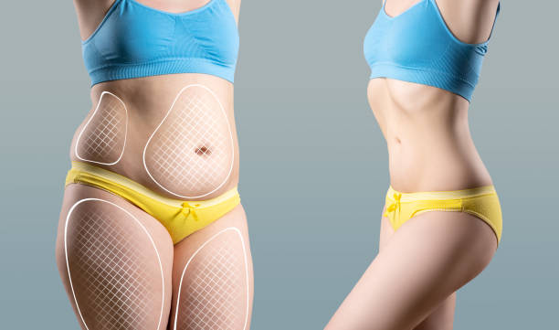Tummy tuck, cellulite removal, woman's body before and after liposuction on gray studio background, plastic surgery concept. Image is not body shape retouched, photos taken at different times after weight loss